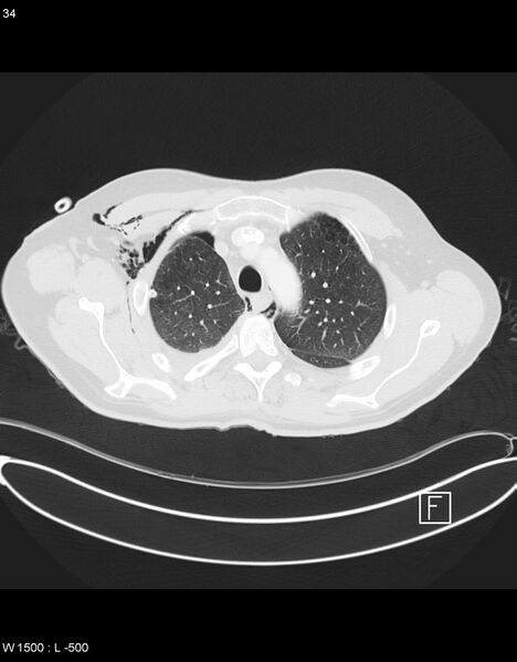 File:Boerhaave syndrome with tension pneumothorax (Radiopaedia 56794-63605 Axial lung window 16).jpg