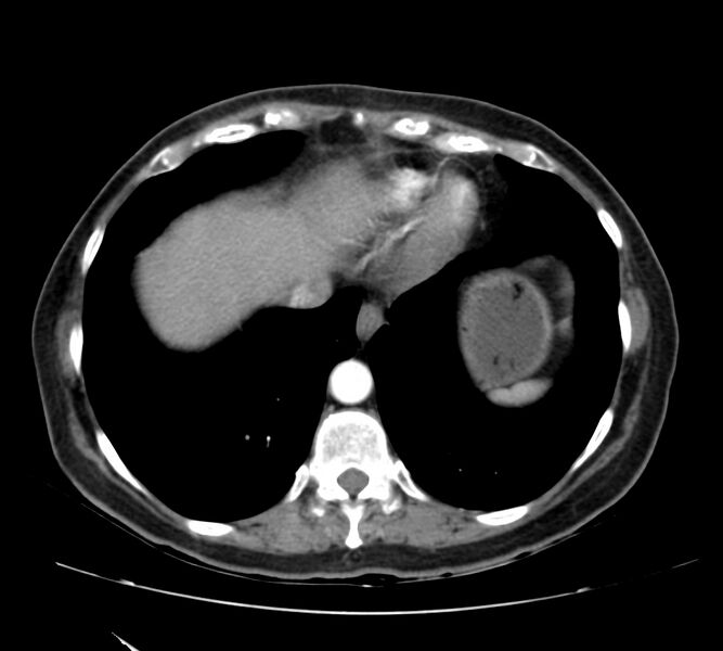 File:Bosniak renal cyst - type IV (Radiopaedia 22929-22953 B 6).jpg