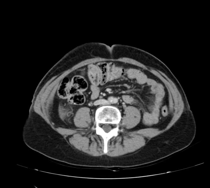 File:Bosniak renal cyst - type IV (Radiopaedia 22929-22953 C 37).jpg