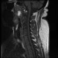 Brachial plexopathy (Radiopaedia 21844-21806 Sagittal T1 5).jpg