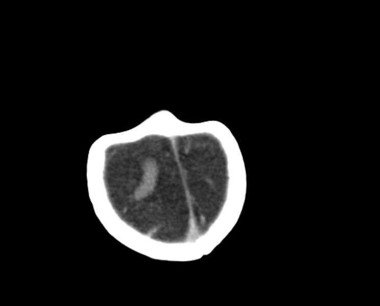 File:Brachycephaly (bi-coronal and bi-lambdoid synostosis) (Radiopaedia 55048-61413 Axial non-contrast 51).jpg