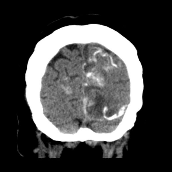 File:Brain cortical laminar necrosis (Radiopaedia 25822-25971 C 48).jpg