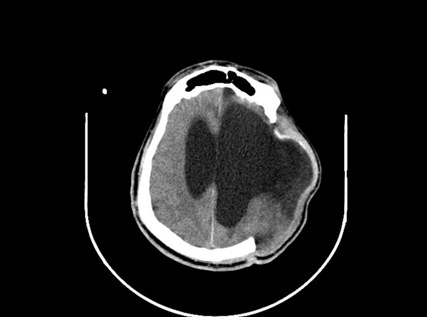 Brain injury by firearm projectile (Radiopaedia 82068-96088 A 150).jpg