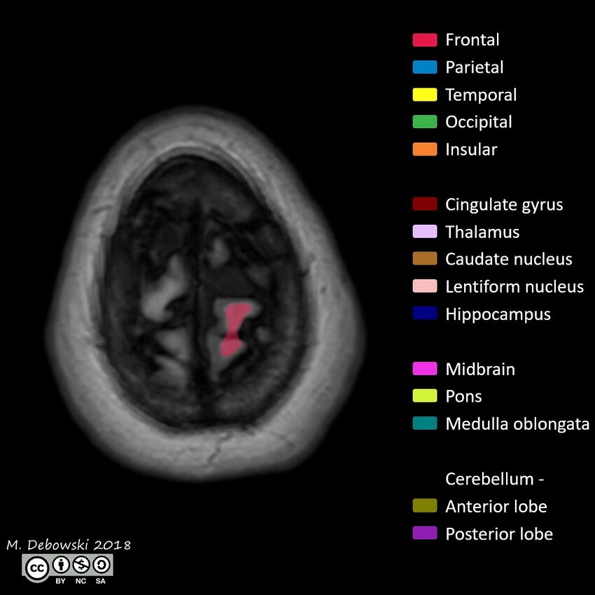 Brain lobes - annotated MRI (Radiopaedia 61691-69700 Axial 1).JPG