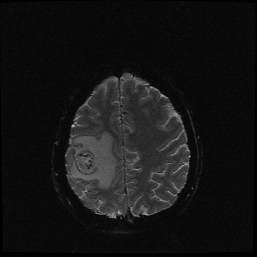Brain metastases (renal cell carcinoma) (Radiopaedia 42571-45704 Axial SWI 11).jpg