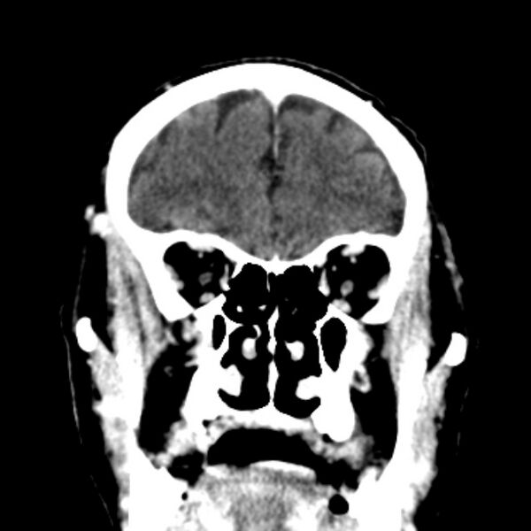 File:Brain metastases from lung cancer (Radiopaedia 27849-28092 Coronal C+ delayed 15).jpg