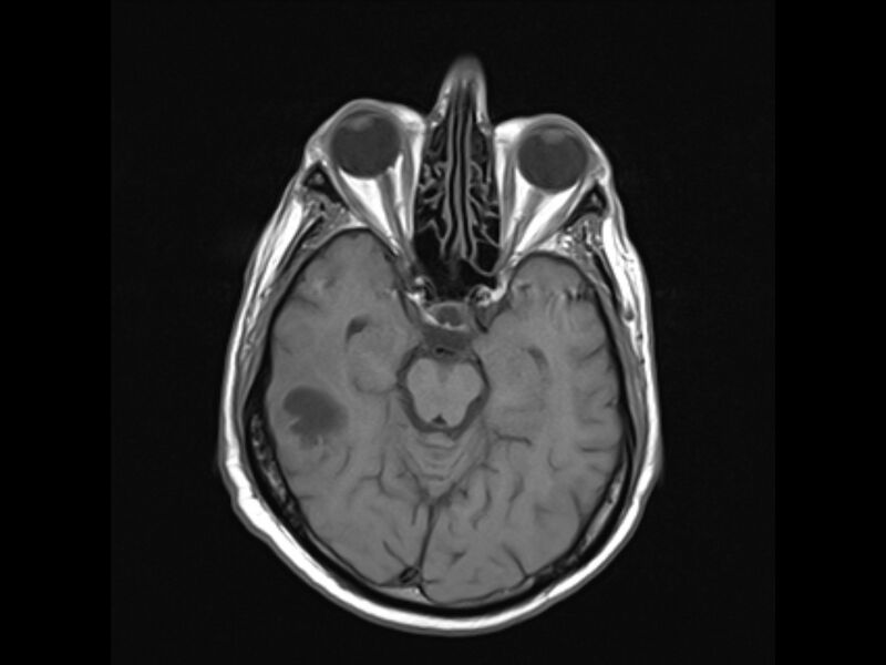 File:Brain metastases from renal cell carcinoma (Radiopaedia 42222-45297 Axial T1 10).jpg
