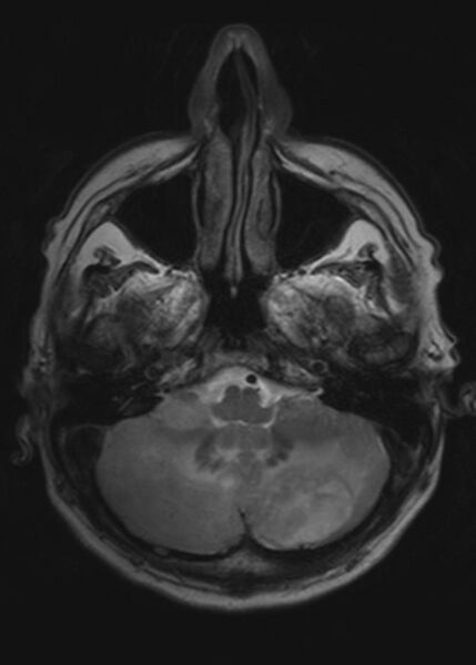 File:Brain metastases from squamocellular lung cancer (Radiopaedia 56515-63222 Axial T2 6).jpg