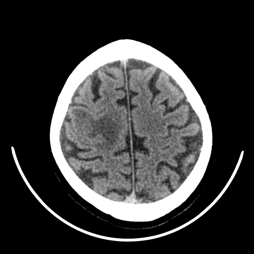 Brain metastasis (Radiopaedia 42617-45760 Axial non-contrast 40).jpg
