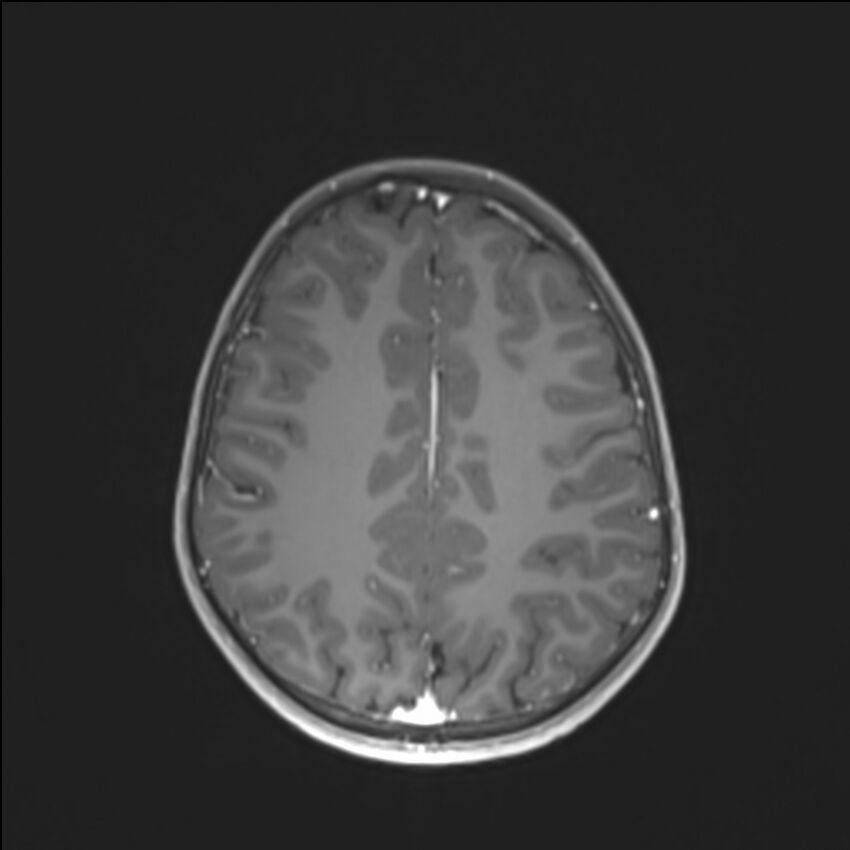 Brainstem glioma (Radiopaedia 70548-80674 Axial T1 C+ 111).jpg