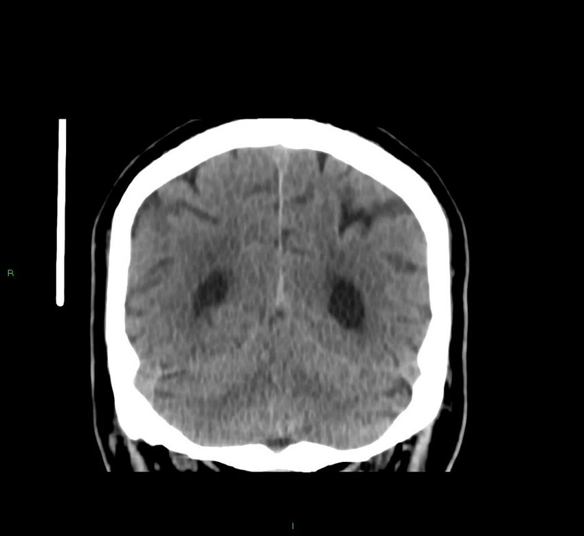 Brainstem hemorrhage (Radiopaedia 58794-66028 Coronal non-contrast 20).jpg