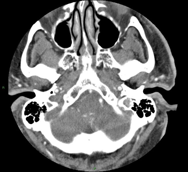 File:Brainstem hemorrhage (Radiopaedia 58794-66028 D 32).jpg