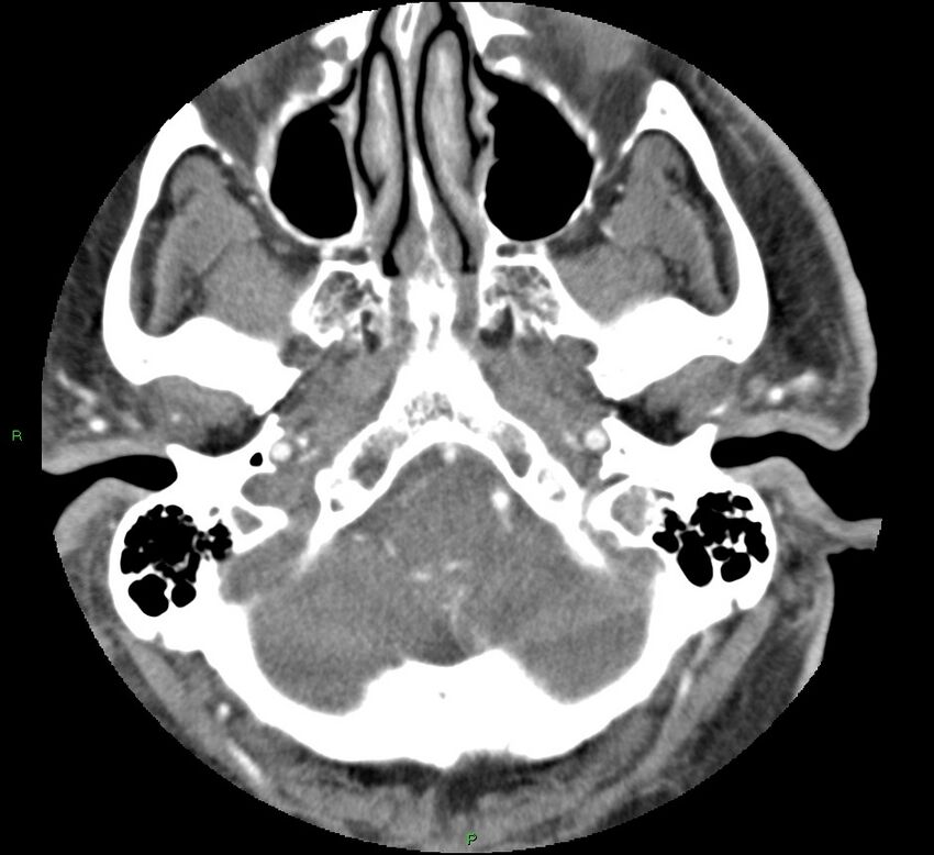 Brainstem hemorrhage (Radiopaedia 58794-66028 D 32).jpg