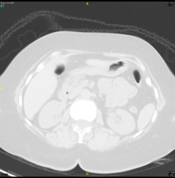 File:Breast primary with lung and bone metastases (Radiopaedia 40620-43228 Axial lung window 57).jpg