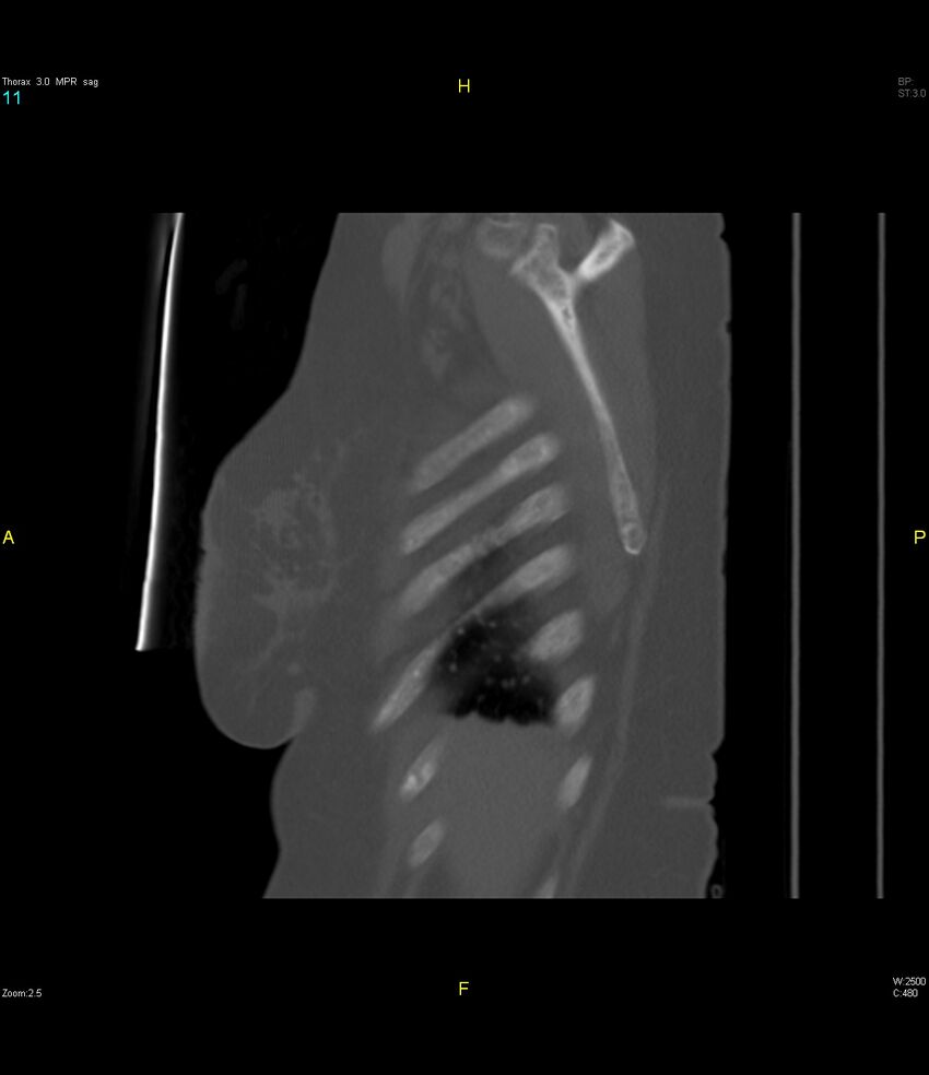 Breast primary with lung and bone metastases (Radiopaedia 40620-43228 Sagittal bone window 11).jpg