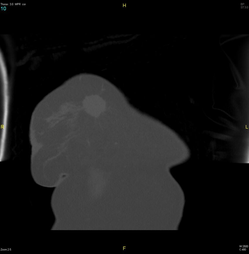 Breast primary with lung and bone metastases (Radiopaedia 40620-43228 bone window 10).jpg