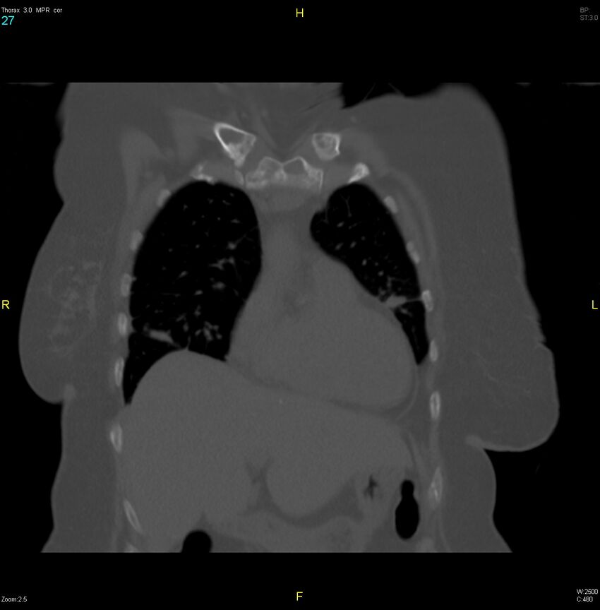 Breast primary with lung and bone metastases (Radiopaedia 40620-43228 bone window 27).jpg