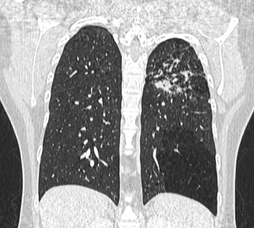Bronchial atresia (Radiopaedia 50007-55297 Coronal lung window 84).jpg