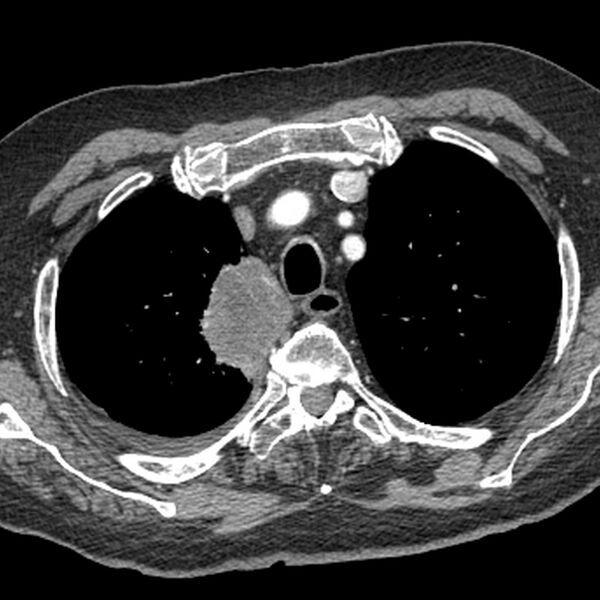 File:Bronchogenic adenocarcinoma and pulmonary embolism (Radiopaedia 9097-9806 A 1).jpg