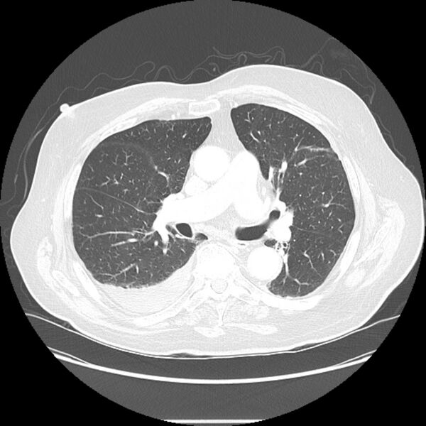 File:Bronchogenic adenocarcinoma and pulmonary embolism (Radiopaedia 9097-9806 Axial lung window 14).jpg