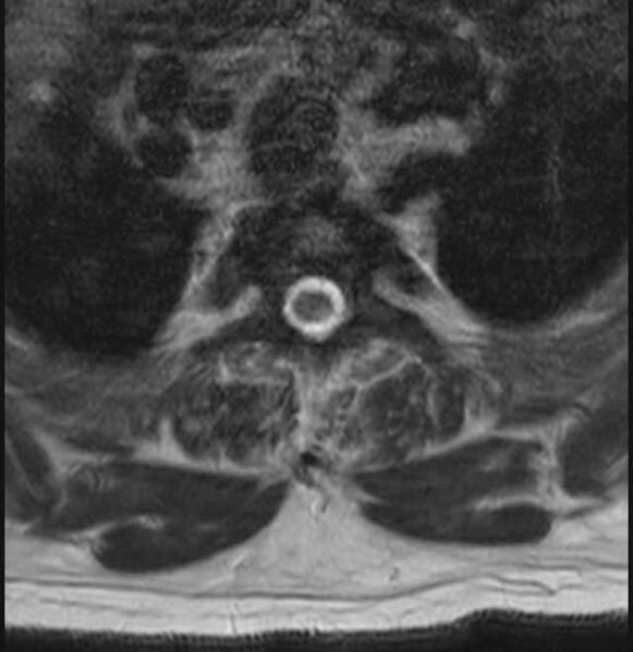 File:Brown tumors compressing the spinal cord (Radiopaedia 68442-78030 A 49).jpg
