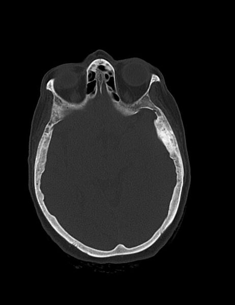File:Burnt-out meningioma (Radiopaedia 51557-57337 Axial bone window 21).jpg