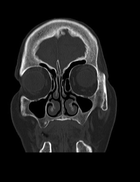 File:Burnt-out meningioma (Radiopaedia 51557-57337 Coronal bone window 7).jpg