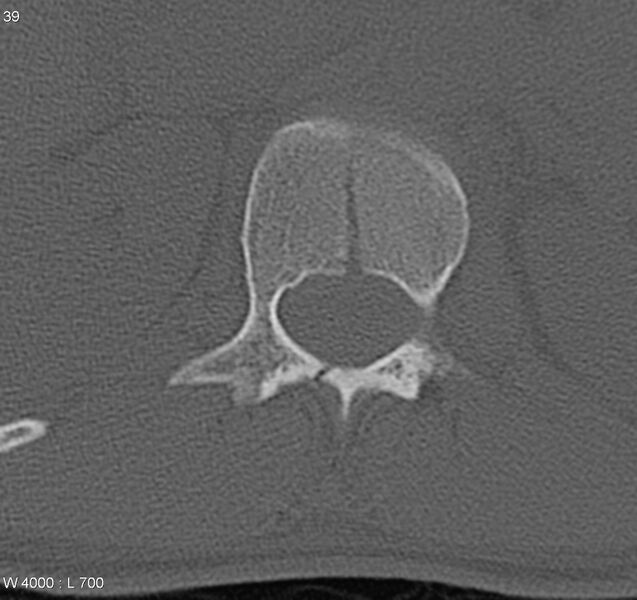 File:Burst fracture (Radiopaedia 5274-7018 Axial bone window 7).jpg