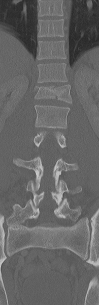 File:Burst fracture - T12 with conus compression (Radiopaedia 56825-63647 Coronal bone window 20).png