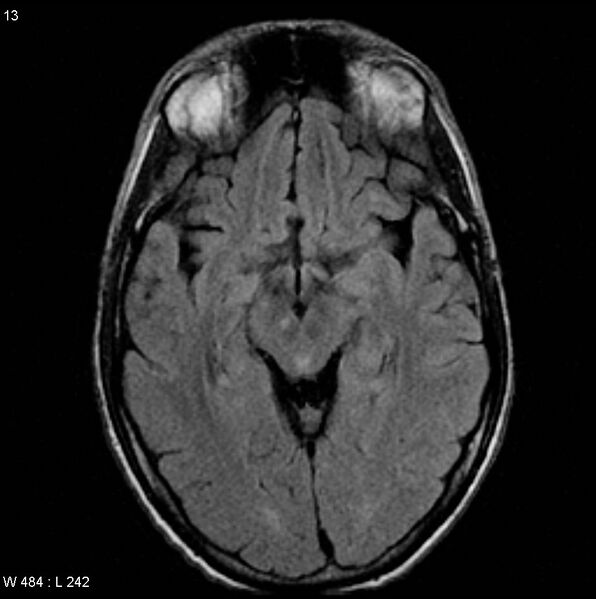 File:CMV ventriculitis and encephalitis (Radiopaedia 5416-7166 Axial FLAIR 2).jpg
