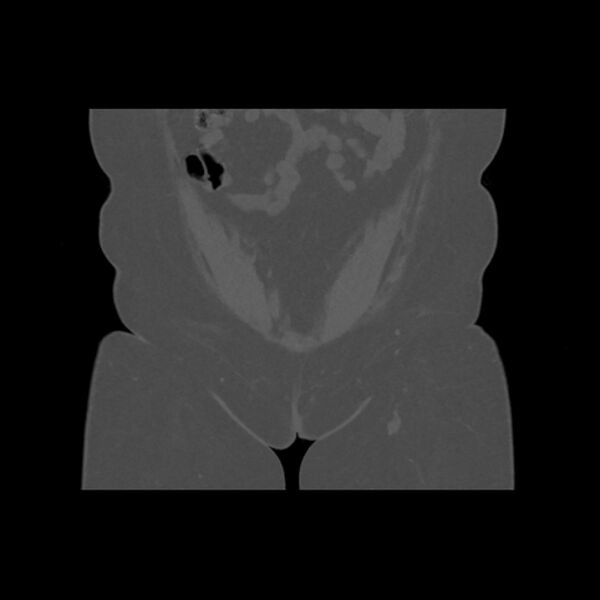 File:Calcific tendinitis of the gluteus medius muscle (Radiopaedia 66998-76318 Coronal bone window 4).jpg