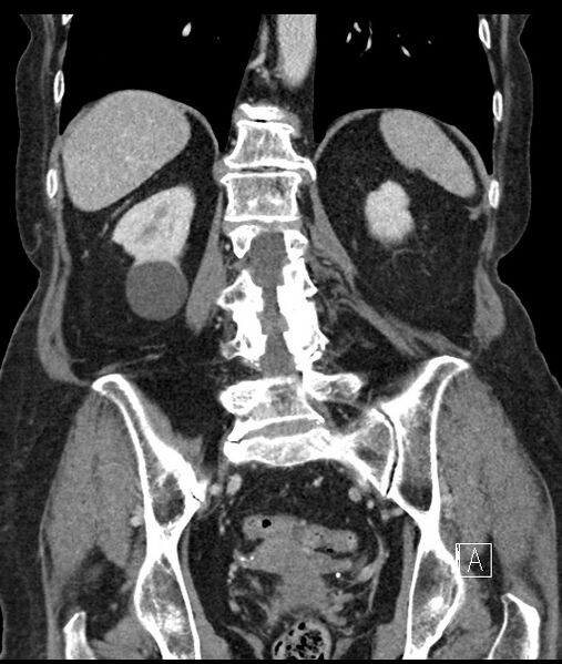 File:Calcified adrenal glands and Spigelian hernia (Radiopaedia 49741-54988 B 81).jpg