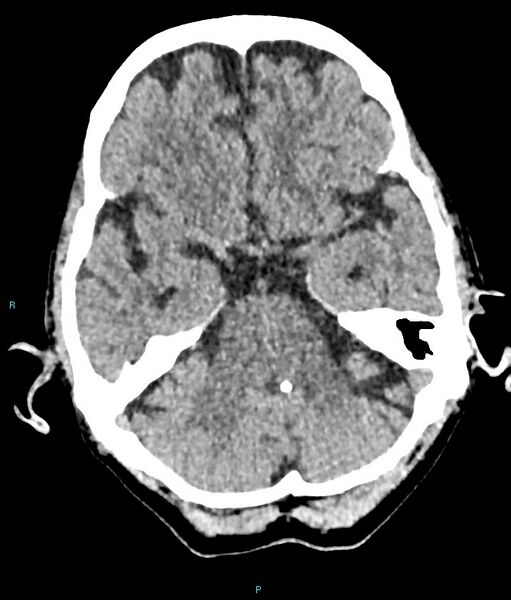 File:Calcified cerebral emboli from left ventricular thrombus (Radiopaedia 84420-99758 Axial non-contrast 67).jpg