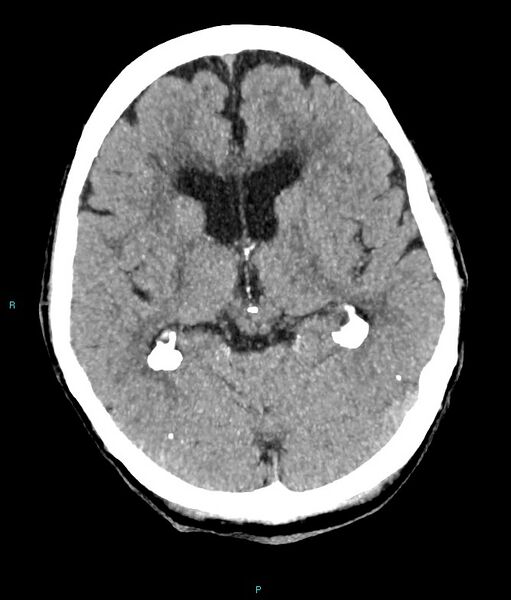File:Calcified cerebral emboli from left ventricular thrombus (Radiopaedia 84420-99758 B 10).jpg