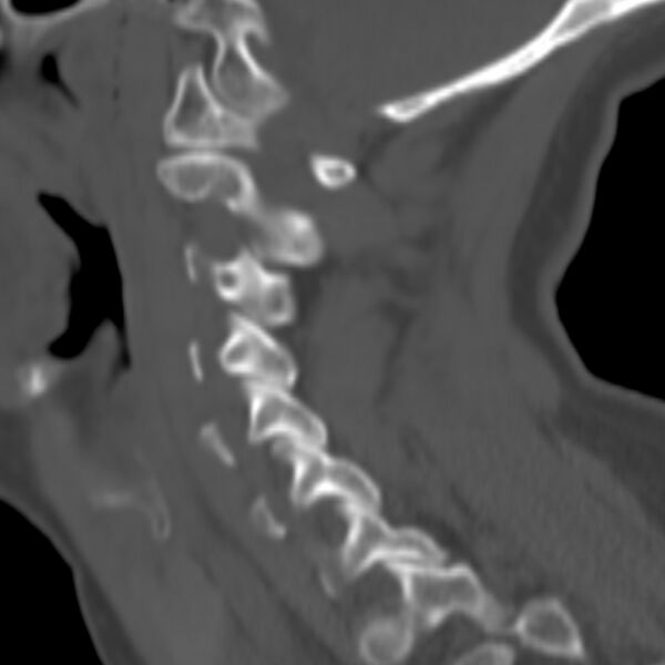 File:Calcified meningioma - cervical canal (Radiopaedia 70136-80171 Sagittal bone window 27).jpg