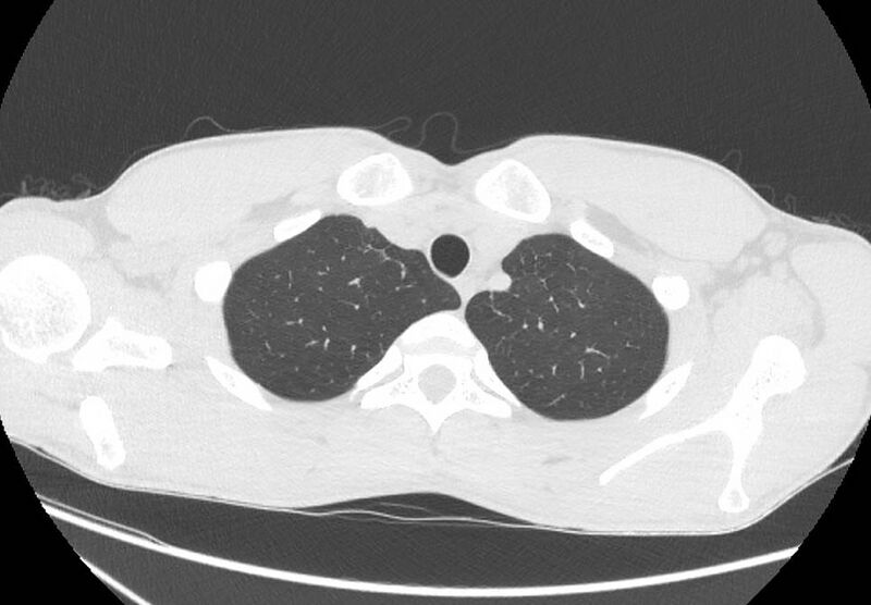File:Cannabis-induced diffuse alveolar hemorrhage (Radiopaedia 89834-106946 Axial lung window 14).jpg