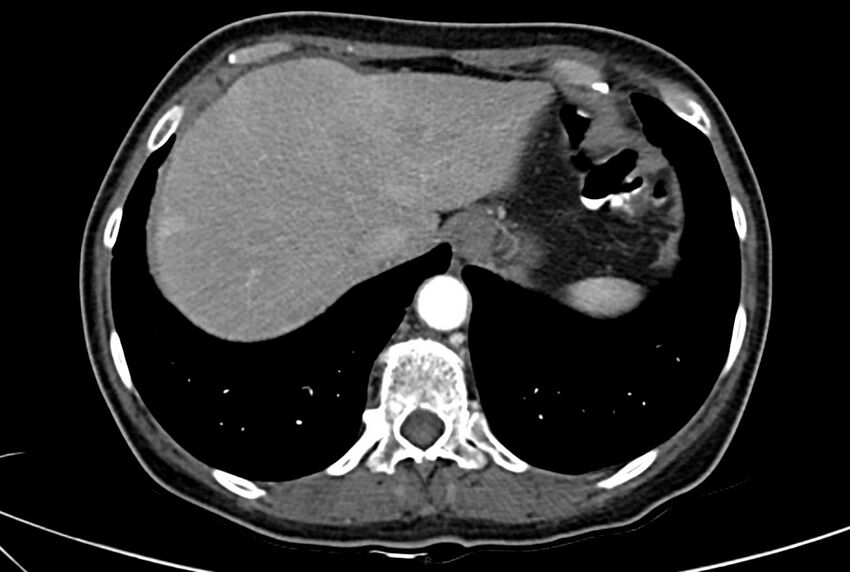 Carcinoid mesenteric tumor complicated by chylous ascites (Radiopaedia 76312-88926 A 9).jpg