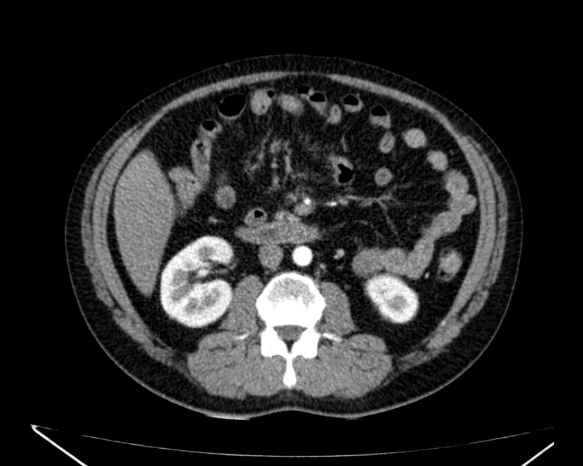 Carcinoid tumor with hepatic metastases (Radiopaedia 22651-22670 B 42).jpg