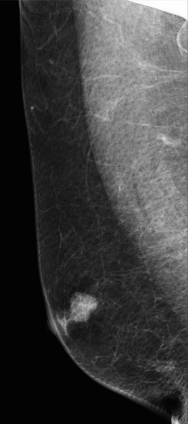 File:Carcinoma of right breast (Radiopaedia 30195-30810 MLO 1).png
