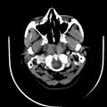 Carotid body tumor (Radiopaedia 27890-28124 A 4).jpg