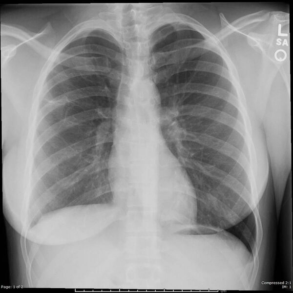 File:Catamenial pneumothorax (Radiopaedia 54382-60602 Frontal 1).jpg
