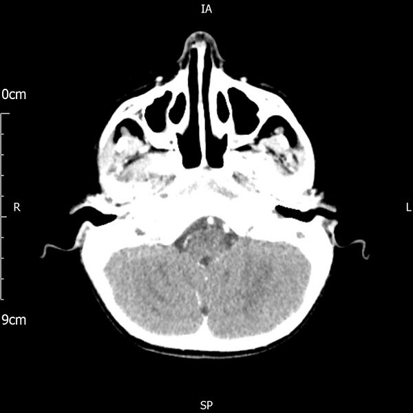 File:Cavernous sinus thrombosis (Radiopaedia 79414-92510 Axial Brain 59).jpg