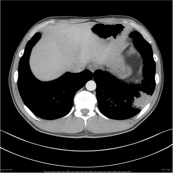 File:Cavitating lung cancer (Radiopaedia 25796-25945 C+ arterial phase 51).jpg