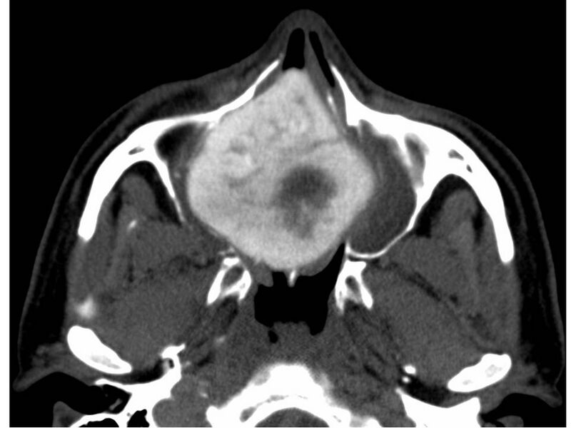 File:Cemento-ossifying fibroma (Radiopaedia 7678-8495 Axial non-contrast 1).jpg