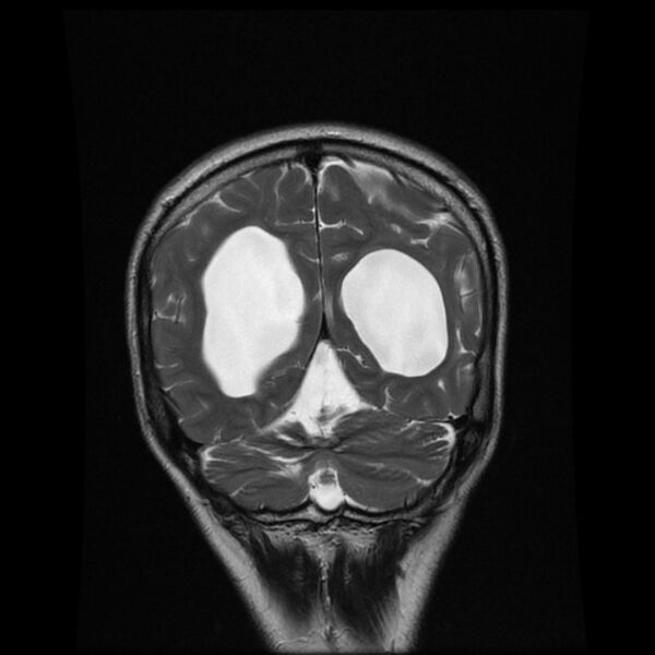 File:Central neurocytoma (Radiopaedia 67618-77021 Coronal T2 18).jpg
