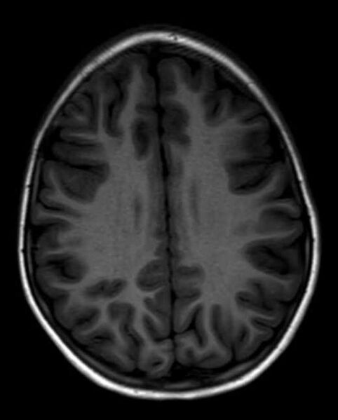 File:Cerebellar abscess (Radiopaedia 73727-84563 Axial T1 23).jpg