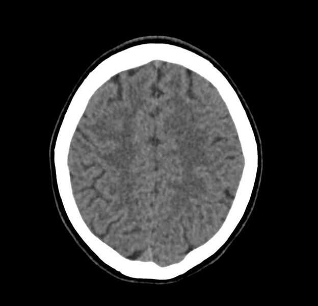 File:Cerebellar agenesis (Radiopaedia 30203-30817 Axial non-contrast 38).jpg