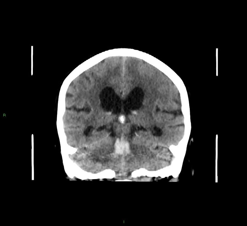 Cerebellar hemorrhage (Radiopaedia 58793-66027 Coronal non-contrast 30).jpg