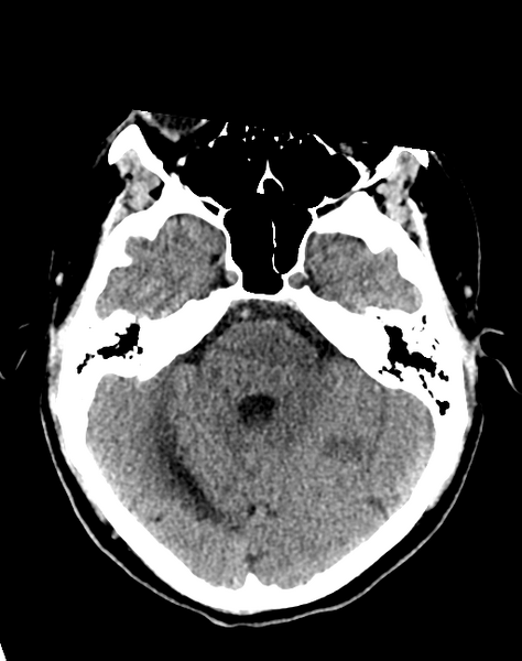 File:Cerebellar infarct due to vertebral artery dissection with posterior fossa decompression (Radiopaedia 82779-97033 Axial non-contrast 12).png