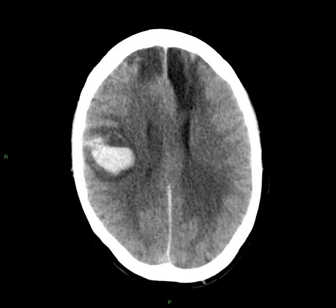 File:Cerebral amyloid angiopathy-associated lobar intracerebral hemorrhage (Radiopaedia 58529-65687 Axial non-contrast 21).jpg